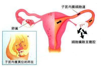 子宫性不孕症