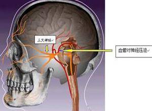 病理性神经损伤