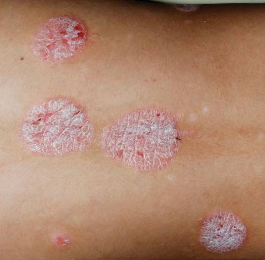 斑块状银屑病