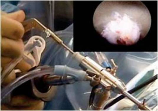 椎间孔镜髓核摘除术