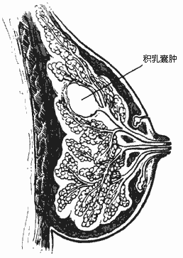 乳腺肿块