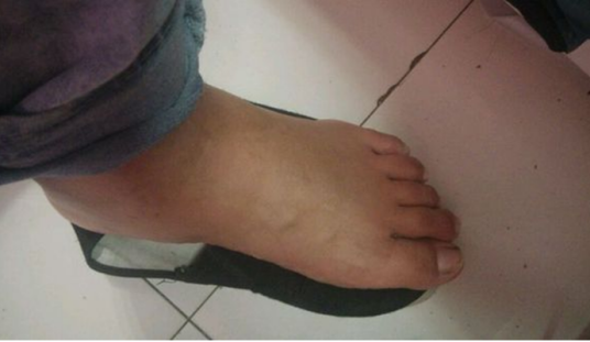 糖尿病脚肿