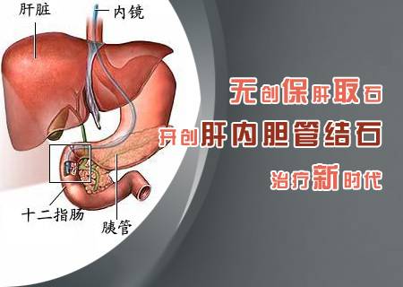 无创保肝取石术