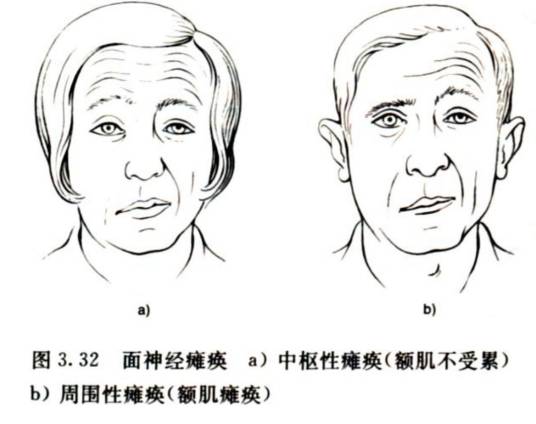 中枢性瘫痪