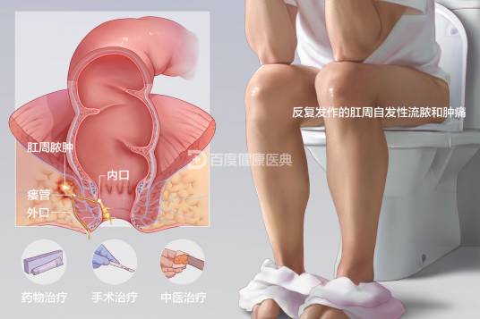 肛瘘