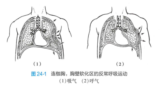 连枷胸