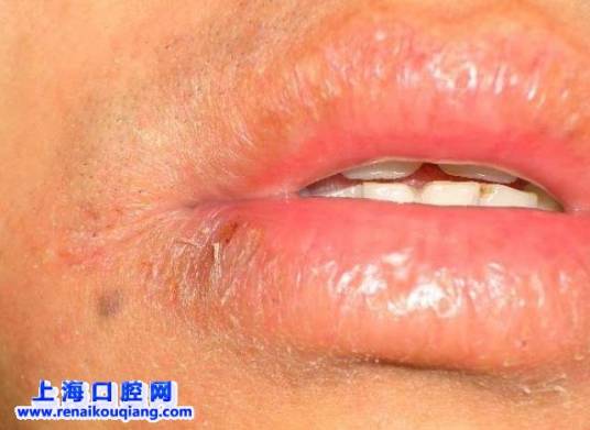 口腔干燥综合征