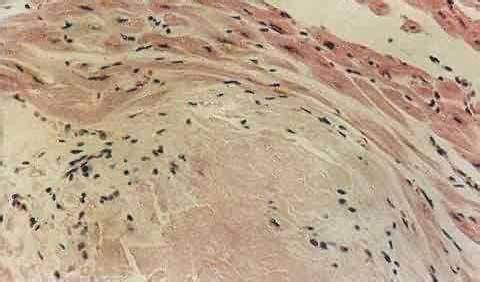 系统性淀粉样变性