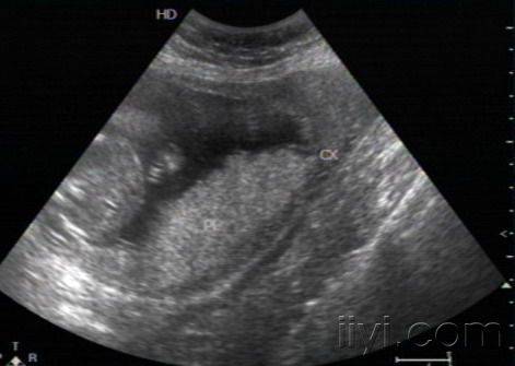 胎盘超声分级
