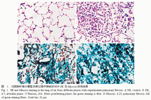 特发性弥漫性肺纤维化