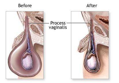 鞘膜积液性不育