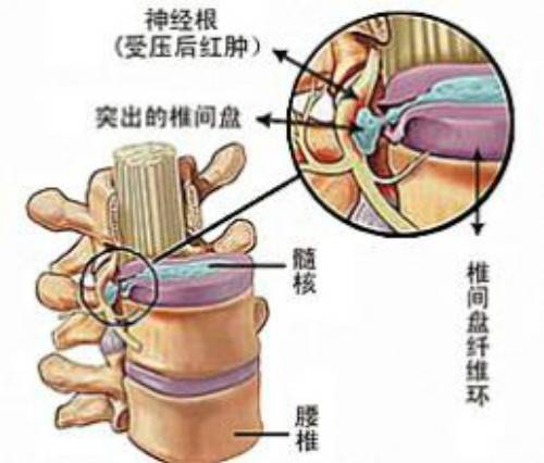 急性腰椎间盘突出
