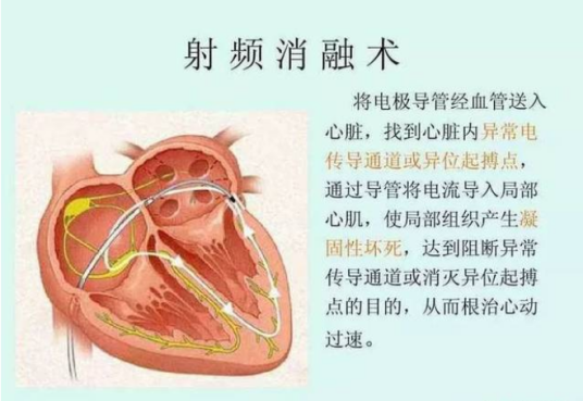 导管射频消融术
