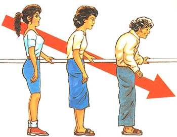 世界骨质疏松日