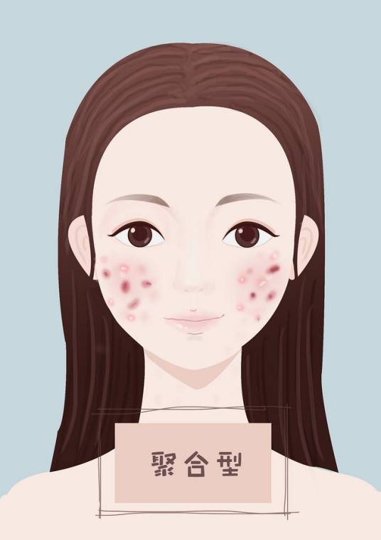 聚合型痤疮