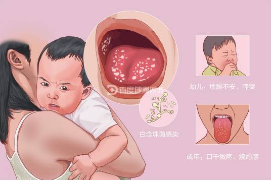 鹅口疮