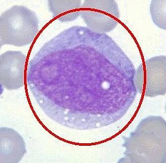 单核细胞增多症