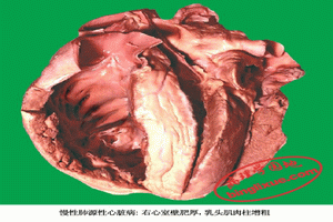 急性肺心病