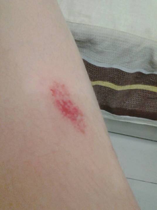 擦伤（外科疾病）