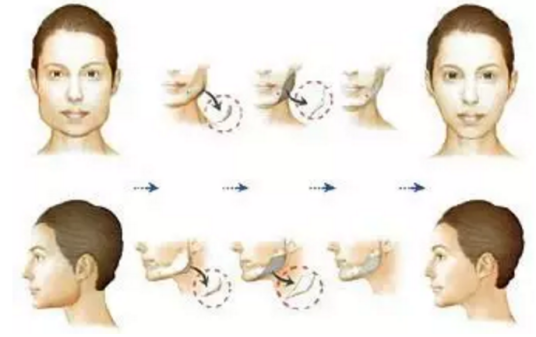 下颌骨整形术