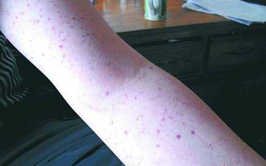 急性血小板减少性紫癜