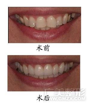 无托槽隐形矫正