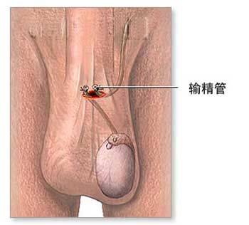 男人结扎