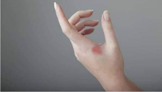 灼伤的急救处理