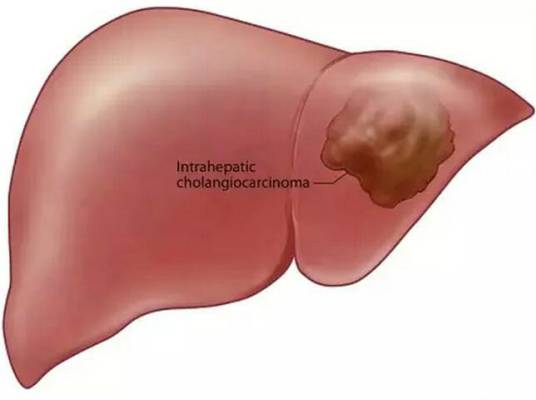 肝内胆管细胞癌