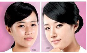歪鼻整复术