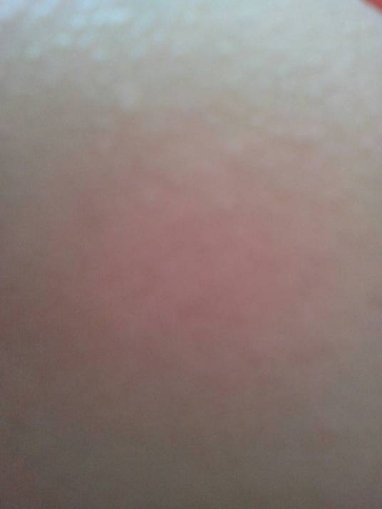 皮肤过敏治疗偏方