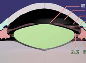 前房色素沉积