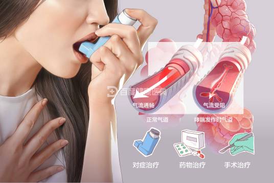 支气管哮喘(哮喘)