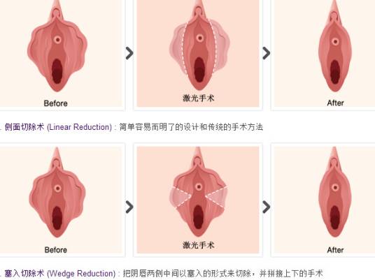 小阴唇整形术