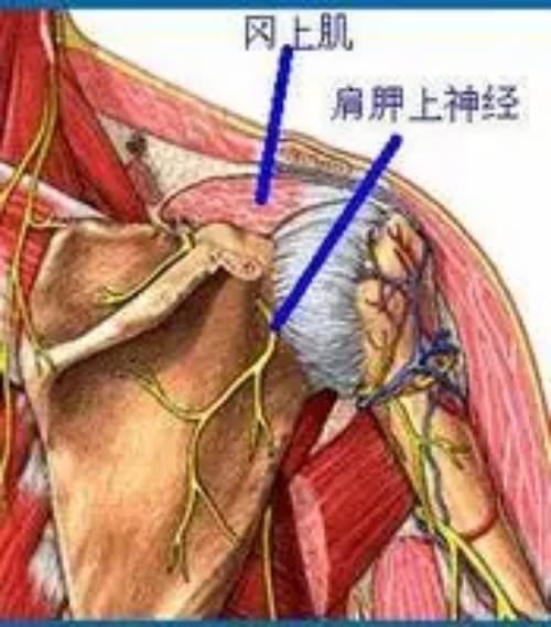 冈上肌腱炎