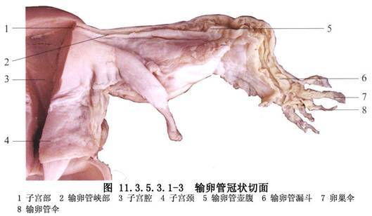 输卵管峡部阻塞