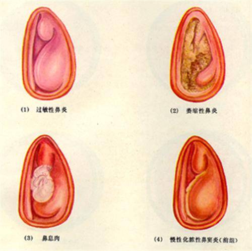 交替性鼻塞