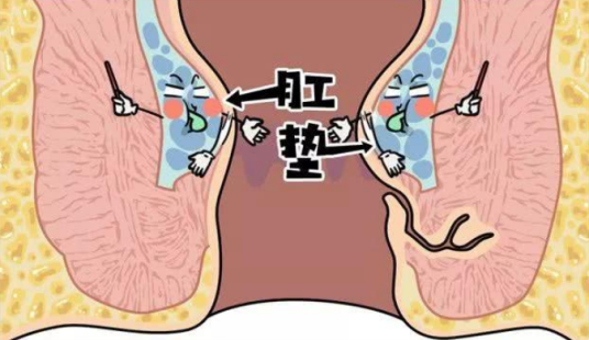 肛垫