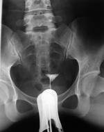 子宫输卵管碘油造影