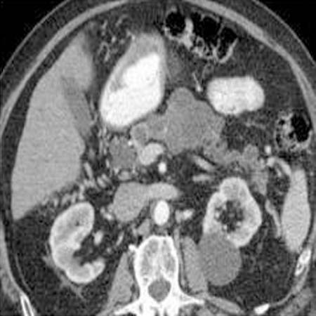 胰腺导管内乳头状粘液瘤
