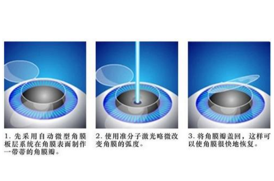 近视眼恢复