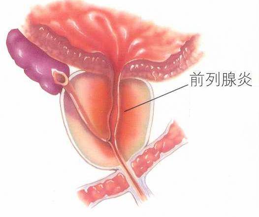 真菌性前列腺炎