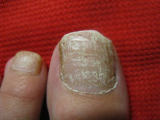 swo（甲真菌病）