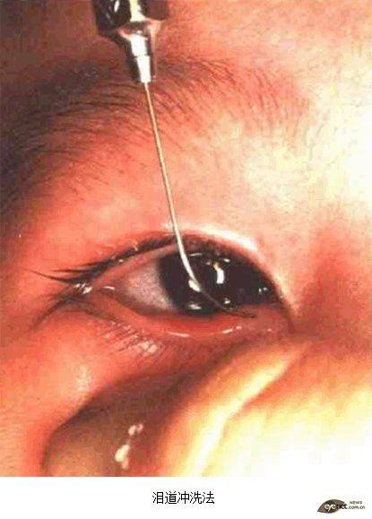 泪道冲洗