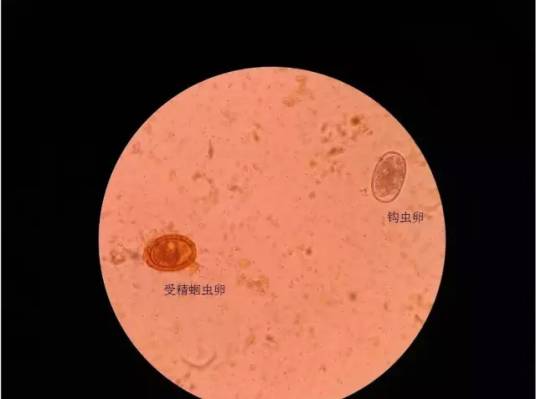 嗜酸性粒细胞计数