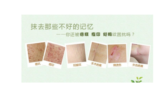 祛疤痕