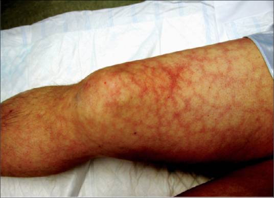 抗磷脂抗体综合征