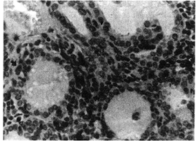 原发性急性肾小球肾炎