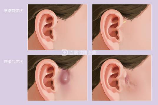 先天性耳前瘘管