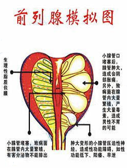 前列腺痛综合症